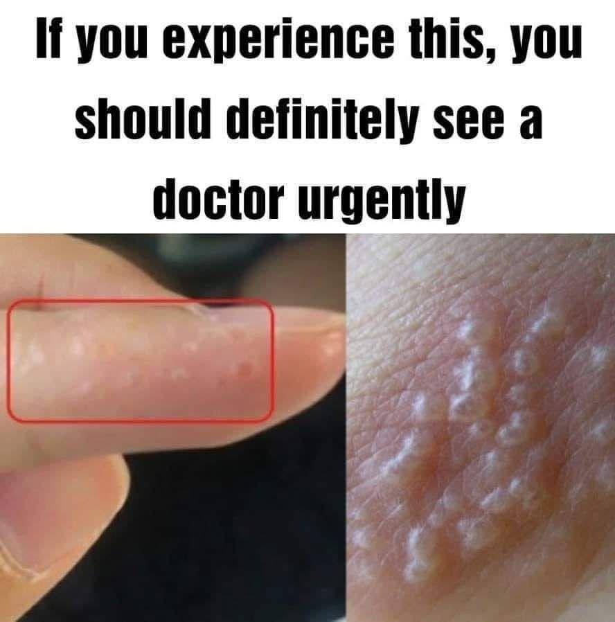 Red Itchy Blisters on Hands or Feet? It Could Be Dyshidrotic Eczema