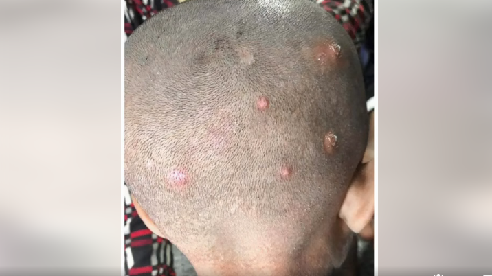 Noticed Bumps on Your Child’s Scalp? Here’s What Parents Should Know