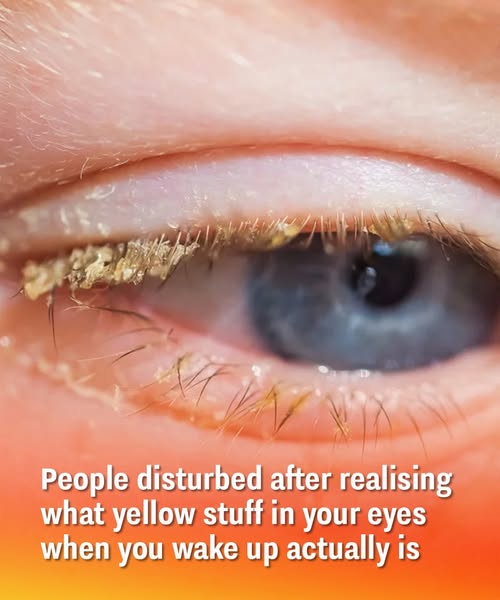 What the Yellow Gunk in Your Eyes Really Means