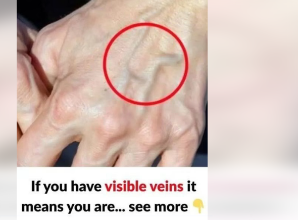 Sudden Bulging Veins? What They Could Mean for Your Health