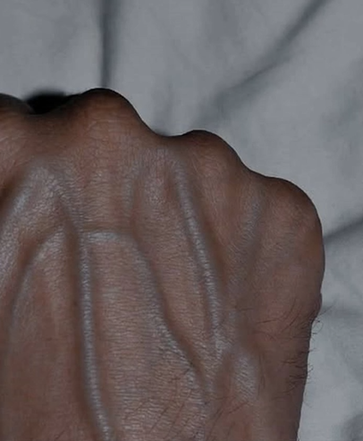 Why Do Veins Suddenly Become Visible? Causes, Risks, and Care Tips