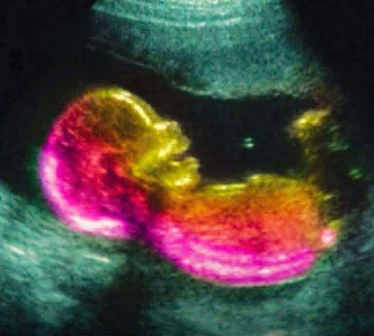 Could a Mother’s Gut Bacteria Influence Autism Risk? New Study Explores the Link