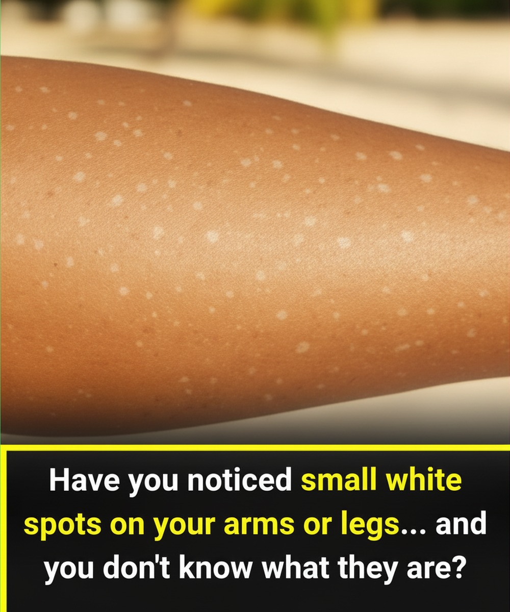 What Vitamin Deficiencies Can Cause White Spots on the Skin